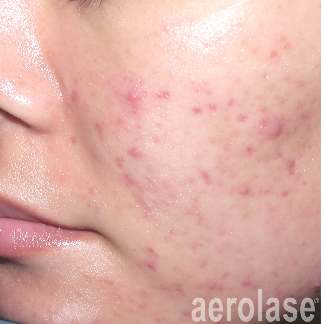 Acne & Acne Scars