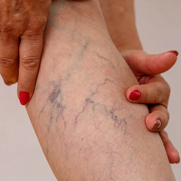 Close-up of a person's leg with visible spider vgeins and a hand gently touching it.